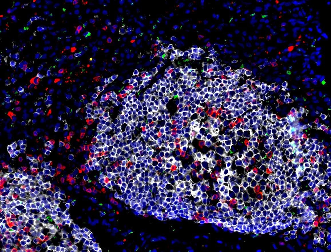 A fluorescence micrograph of lung tissue. Cell nuclei are stained blue, forming a dense rounded cluster; individual cells scattered through and around it are picked out in green and red.